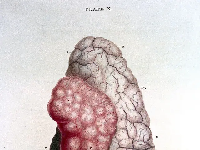 The image shows a diagram of the human brain, with the hematoma of the brain clearly visible. The...